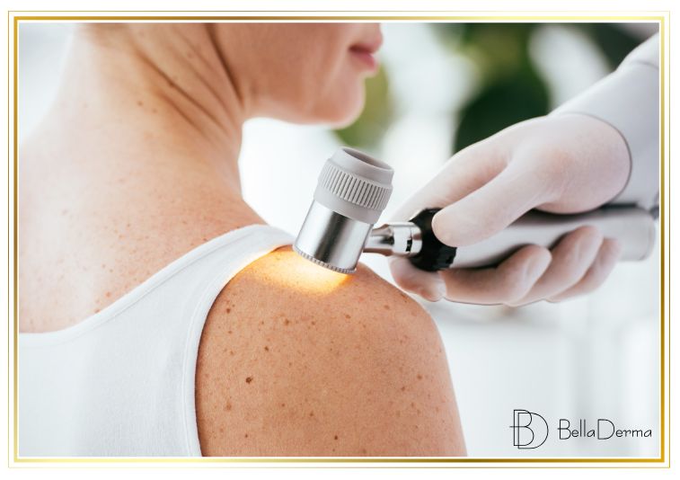 Vyšetření znamének dermatoskopem