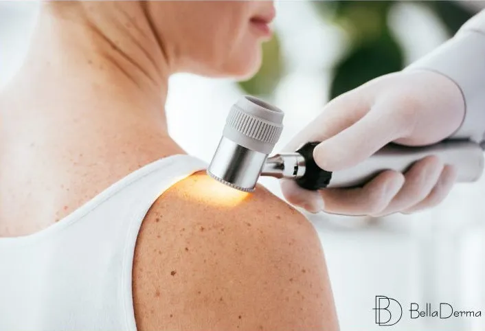 Vyšetření znamének dermatoskopem